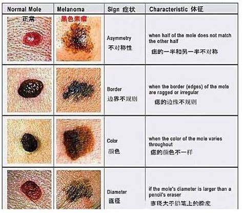 腰上长痣|关于痣你不知道的事儿